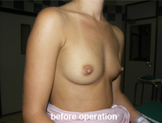 plastic-surgery-breast-augmentation 